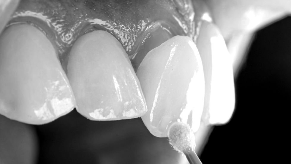 Veneers